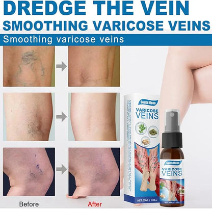 South Moon - Varicose Veins spray pain relief